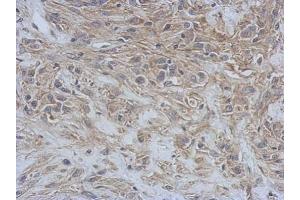 IHC-P Image Immunohistochemical analysis of paraffin-embedded U373 xenograft, using RAP1GDS1, antibody at 1:500 dilution. (RAP1GDS1 antibody  (N-Term))