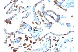 Formalin-fixed, paraffin-embedded human Lung Carcinoma stained with Milk Fat Globule Monoclonal Antibody (MFG-06)