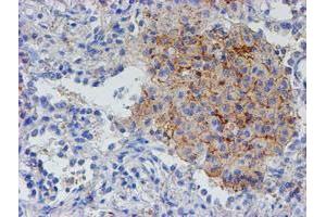 Immunohistochemical staining of paraffin-embedded Carcinoma of Human lung tissue using anti-RFXANK mouse monoclonal antibody. (RFXANK antibody)