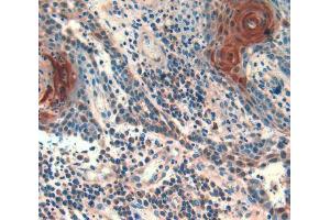 IHC-P analysis of skin cancer tissue, with DAB staining. (Follistatin antibody  (AA 35-283))