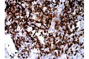 Immunohistochemical analysis of paraffin-embedded lung cancer tissues using CD2 mouse mAb with DAB staining.