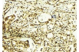 ABIN6267408 at 1/100 staining Human breast cancer tissue by IHC-P. (PKC antibody  (pThr497))