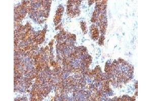 Formalin-fixed, paraffin-embedded human parathyroid stained with Parathyroid Hormone antibody (PTH/1173).