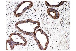 IHC-P: Smad2 antibody testing of human breast cancer tissue (SMAD2 antibody  (N-Term))