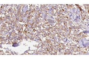 ABIN6276935 at 1/100 staining Human Melanoma tissue by IHC-P. (IL-24 antibody  (Internal Region))
