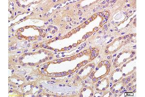 Formalin-fixed and paraffin embedded human kidney carcinoma labeled with Anti phospho-IGF1R(Tyr980) Polyclonal Antibody,Unconjugated (ABIN802203) at 1:200 followed by conjugation to the secondary antibody and DAB staining (IGF1R antibody  (pTyr980))