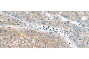 Immunohistochemistry of paraffin-embedded Human liver cancer tissue using UBE2G2 Polyclonal Antibody at dilution of 1:55(x200)