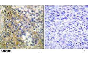 Immunohistochemistry analysis of paraffin-embedded human cervix carcinoma tissue using COL4A6 polyclonal antibody . (COL4a6 antibody)