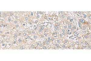 Immunohistochemistry of paraffin-embedded Human liver cancer tissue using RAC2 Polyclonal Antibody at dilution of 1:60(x200) (RAC2 antibody)