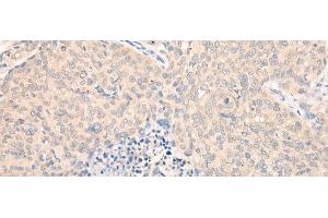 Immunohistochemistry of paraffin-embedded Human cervical cancer tissue using SEPT10 Polyclonal Antibody at dilution of 1:25(x200) (Septin 10 antibody)