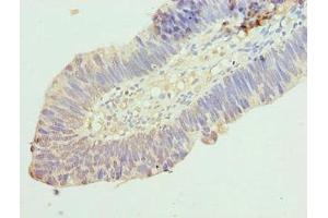 Immunohistochemistry of paraffin-embedded human ovarian cancer using ABIN7167036 at dilution of 1:100 (RINT1 antibody  (AA 401-700))