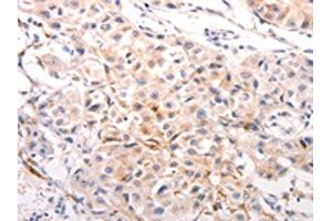 The image on the left is immunohistochemistry of paraffin-embedded Human breast cancer tissue using ABIN7191245(KRT6A/KRT6B/KRT6C/KRT6B/KRT6C Antibody) at dilution 1/40, on the right is treated with synthetic peptide. (KRT6A/KRT6B/KRT6C antibody)