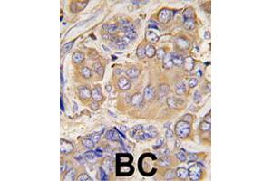 Formalin-fixed and paraffin-embedded human breast carcinoma tissue reacted with HSPB1 polyclonal antibody  , which was peroxidase-conjugated to the secondary antibody, followed by DAB staining. (HSP27 antibody  (Ser78))