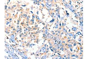 The image on the left is immunohistochemistry of paraffin-embedded Human esophagus cancer tissue using ABIN7129275(DUSP14 Antibody) at dilution 1/20, on the right is treated with fusion protein. (DUSP14 antibody)