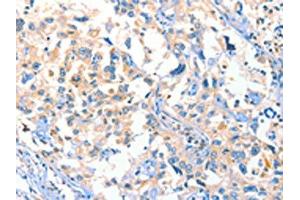 The image on the left is immunohistochemistry of paraffin-embedded Human esophagus cancer tissue using ABIN7129275(DUSP14 Antibody) at dilution 1/20, on the right is treated with fusion protein.