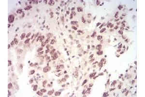 Immunohistochemical analysis of paraffin-embedded endometrial cancer tissues using WTAP mouse mAb with DAB staining. (WTAP antibody  (AA 91-201))
