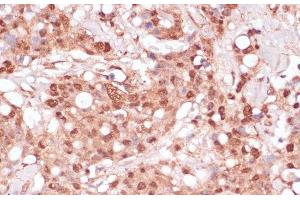 Immunohistochemistry of paraffin-embedded Human breast cancer using BYSL Polyclonal Antibody at dilution of 1:100 (40x lens). (Bystin-Like antibody)