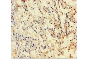 Immunohistochemistry of paraffin-embedded human lung cancer using ABIN7149900 at dilution of 1:100 (Dihydrofolate Reductase antibody  (AA 2-187))
