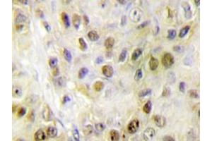 Immunohistochemistry analyzes of RORα antibody in paraffin-embedded human breast carcinoma tissue. (RORA antibody)