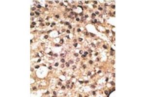 Formalin-fixed and paraffin-embedded human cancer tissue reacted with the primary antibody, which was peroxidase-conjugated to the secondary antibody, followed by DAB staining. (ATG4B antibody  (N-Term))