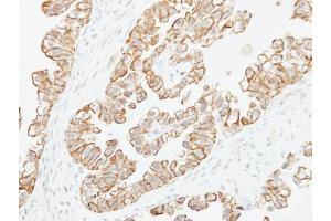 IHC-P Image Immunohistochemical analysis of paraffin-embedded human ovarian cancer, using Adenylate cyclase 2, antibody at 1:250 dilution. (ADCY2 antibody)