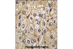 Formalin-fixed and paraffin-embedded human hepatocarcinoma tissue reacted with EphA7 antibody , which was peroxidase-conjugated to the secondary antibody, followed by DAB staining. (EPH Receptor A7 antibody)