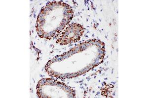 Anti-MTCO1 antibody, IHC(P): Human Mammary Cancer Tissue (COX1 antibody  (C-Term))