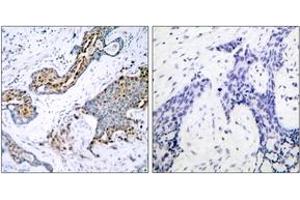 Immunohistochemistry analysis of paraffin-embedded human breast carcinoma, using Estrogen Receptor-alpha (Phospho-Ser118) Antibody. (Estrogen Receptor alpha antibody  (pSer118))