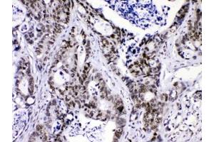IHC testing of FFPE human intestinal cancer with hnRNP F antibody at 1ug/ml. (HNRNPF antibody  (AA 23-53))