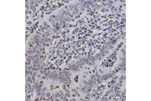 Immunohistochemistry of paraffin-embedded human colon carcinoma using MonoMethyl-Histone H3-K9 antibody (ABIN7267685) at dilution of 1:100 (40x lens). (Histone 3 antibody  (H3K9me))