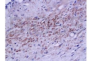 Formalin-fixed and paraffin embedded human prostate labeled with Rabbit Anti phospho-Androgen Receptor(Ser578) Polyclonal Antibody, Unconjugated (ABIN730123) at 1:200 followed by conjugation to the secondary antibody and DAB staining (Androgen Receptor antibody  (pSer578))