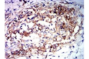 Immunohistochemical analysis of paraffin-embedded stomach cancer tissues using MUC2 mouse mAb with DAB staining. (MUC2 antibody  (AA 4373-4557))