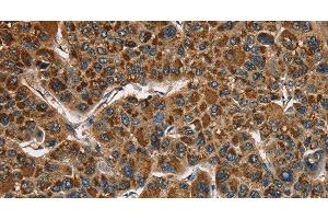 Immunohistochemistry of paraffin-embedded Human liver cancer using CAT Polyclonal Antibody at dilution of 1:40 (Catalase antibody)