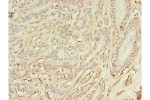 Immunohistochemistry of paraffin-embedded human breast cancer using ABIN7144179 at dilution of 1:100 (ASB11 antibody  (AA 41-315))