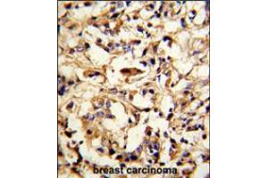 Formalin-fixed and paraffin-embedded human breast carcinoma reacted with DFNA5 Antibody (N-term), which was peroxidase-conjugated to the secondary antibody, followed by DAB staining. (DFNA5 antibody  (N-Term))