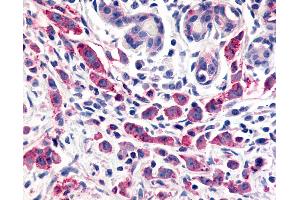 Anti-ELTD1 antibody IHC of human Breast, Carcinoma. (ELTD1 antibody  (N-Term))