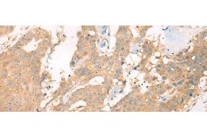 Immunohistochemistry of paraffin-embedded Human colorectal cancer tissue using ASIC3 Polyclonal Antibody at dilution of 1:40(x200) (ASIC3 antibody)