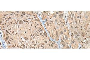Immunohistochemistry of paraffin-embedded Human esophagus cancer tissue using ZNF468 Polyclonal Antibody at dilution of 1:30(x200) (ZNF468 antibody)