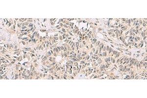 Immunohistochemistry of paraffin-embedded Human ovarian cancer tissue using RNF13 Polyclonal Antibody at dilution of 1:60(x200) (RNF13 antibody)