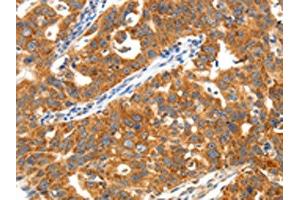 The image on the left is immunohistochemistry of paraffin-embedded Human ovarian cancer tissue using ABIN7192878(TRAF3 Antibody) at dilution 1/40, on the right is treated with synthetic peptide. (TRAF3 antibody)