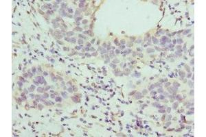 Immunohistochemistry of paraffin-embedded human bladder cancer using ABIN7155947 at dilution of 1:100 (HAPLN1 antibody  (AA 165-354))
