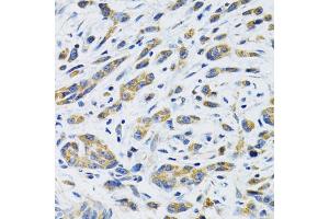 Immunohistochemistry of paraffin-embedded human gastric cancer using SLC16A4 antibody. (SLC16A4 antibody)