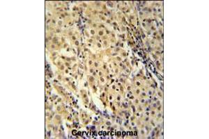 immunohistochemistry analysis in formalin fixed and paraffin embedded human cervix carcinoma followed by peroxidase conjugation of the secondary antibody and DAB staining. (FOXC2 antibody  (AA 159-186))