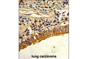 Formalin-fixed and paraffin-embedded human lung carcinoma with S Antibody (C-term), which was peroxidase-conjugated to the secondary antibody, followed by DAB staining. (Osteopontin antibody  (C-Term))