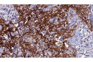 ABIN6279138 at 1/100 staining Human Head and neck cancer tissue by IHC-P. (Aquaporin 8 antibody  (N-Term))