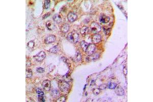 Immunohistochemical analysis of PDHA1 staining in human lung cancer formalin fixed paraffin embedded tissue section. (PDHA1 antibody  (C-Term))