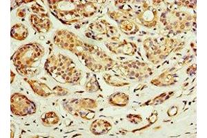 Immunohistochemistry of paraffin-embedded human breast cancer using ABIN7143229 at dilution of 1:100 (ACSM3 antibody  (AA 387-586))