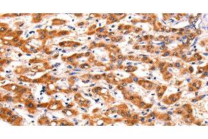 Immunohistochemistry of paraffin-embedded Human liver cancer tissue using FBLN1 Polyclonal Antibody at dilution 1:47 (Fibulin 1 antibody)