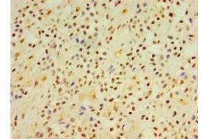 Immunohistochemistry of paraffin-embedded human breast cancer using ABIN7149845 at dilution of 1:100 (DGKE antibody  (AA 40-260))
