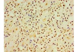 Immunohistochemistry of paraffin-embedded human breast cancer using ABIN7149845 at dilution of 1:100 (DGKE antibody  (AA 40-260))